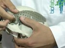 Técnica inédita no país cria próteses de titânio