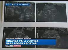 Grávida recorre à Justiça por direito de abortar siameses