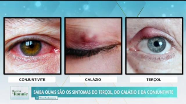 AMO Oftalmologia - Terçol e Calázio: qual é a diferença? 🤔 👀 O