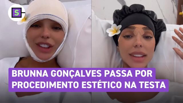 Brunna Gonçalves mostra resultado pós-operatório de frontoplastia