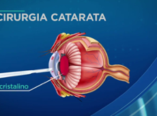 Cirurgia de catarata aumenta 40% no Brasil