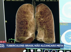 Brasil não alcançará a meta de eliminar a tuberculose até 2030